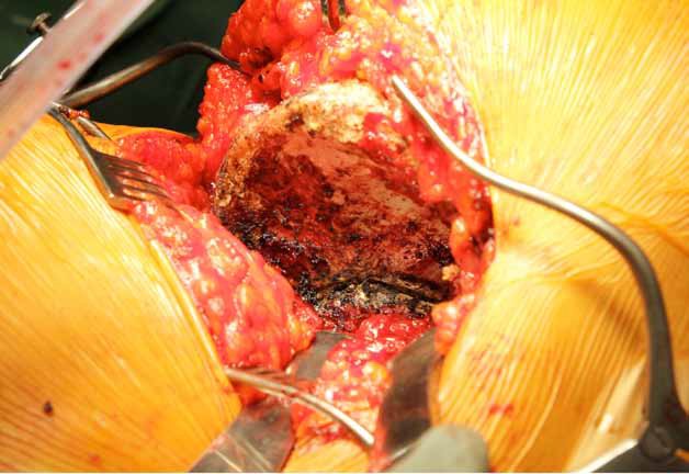 Sacroiliac Joint Dysfunction Treatment 4
